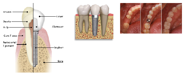 dental_implants