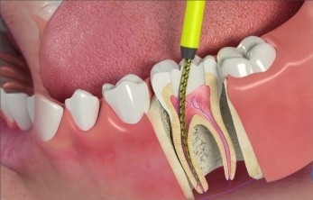 root-canal1