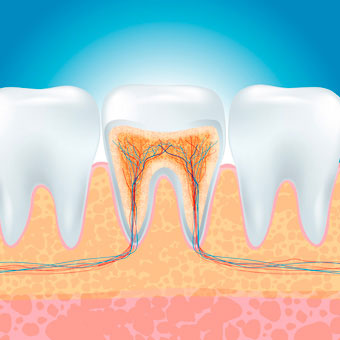 root-canal2